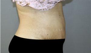 Tummy Tuck