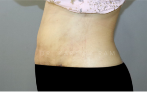 Tummy Tuck