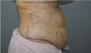 Tummy Tuck