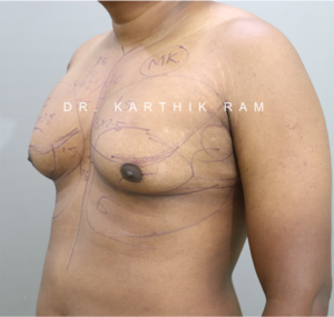 Gynecomastia (Puffy Nipples/ Male Chest Correction)