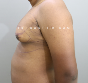 Gynecomastia (Puffy Nipples/ Male Chest Correction)