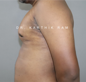 Gynecomastia (Puffy Nipples/ Male Chest Correction)