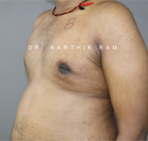 Gynecomastia (Puffy Nipples/ Male Chest Correction)