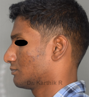 Rhinoplasty (Nose Corrections)