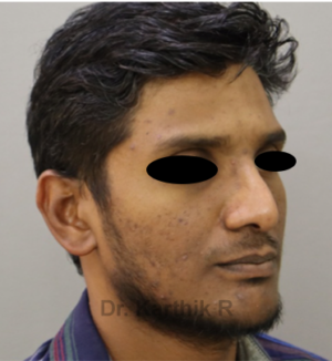 Rhinoplasty (Nose Corrections)