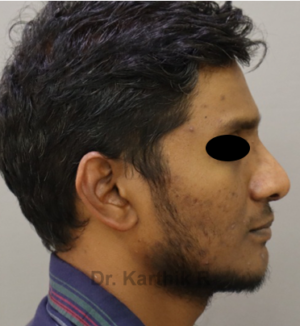 Rhinoplasty (Nose Corrections)