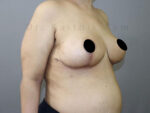 Breast Reduction and Breast Lift