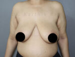 Breast Reduction and Breast Lift