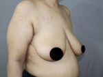 Breast Reduction and Breast Lift