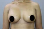 Breast Implants (Breast Augmentation)