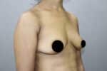 Breast Implants (Breast Augmentation)