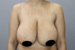 Breast Reduction and Breast Lift