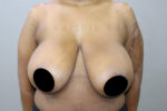 Breast Reduction and Breast Lift