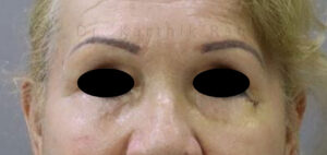 Blepharoplasty