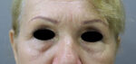 Blepharoplasty