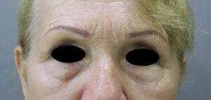 Blepharoplasty