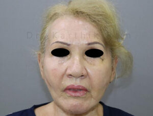 Blepharoplasty