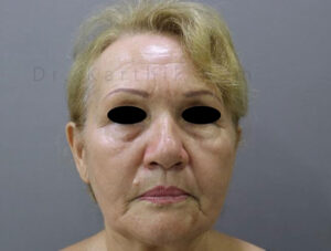 Blepharoplasty