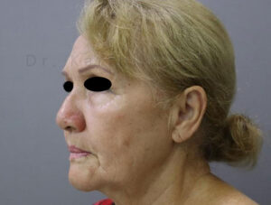 Blepharoplasty