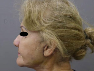 Blepharoplasty