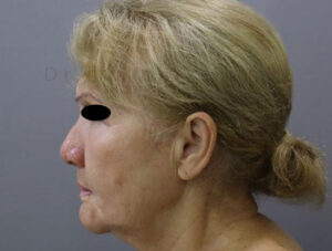 Blepharoplasty