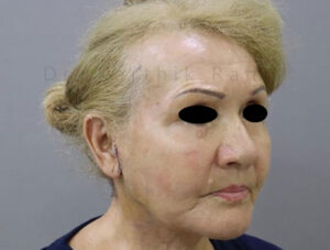 Blepharoplasty