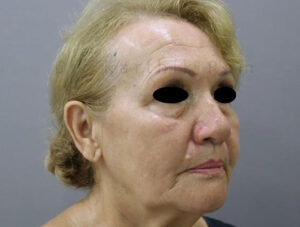 Blepharoplasty