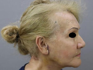 Blepharoplasty