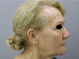 Blepharoplasty