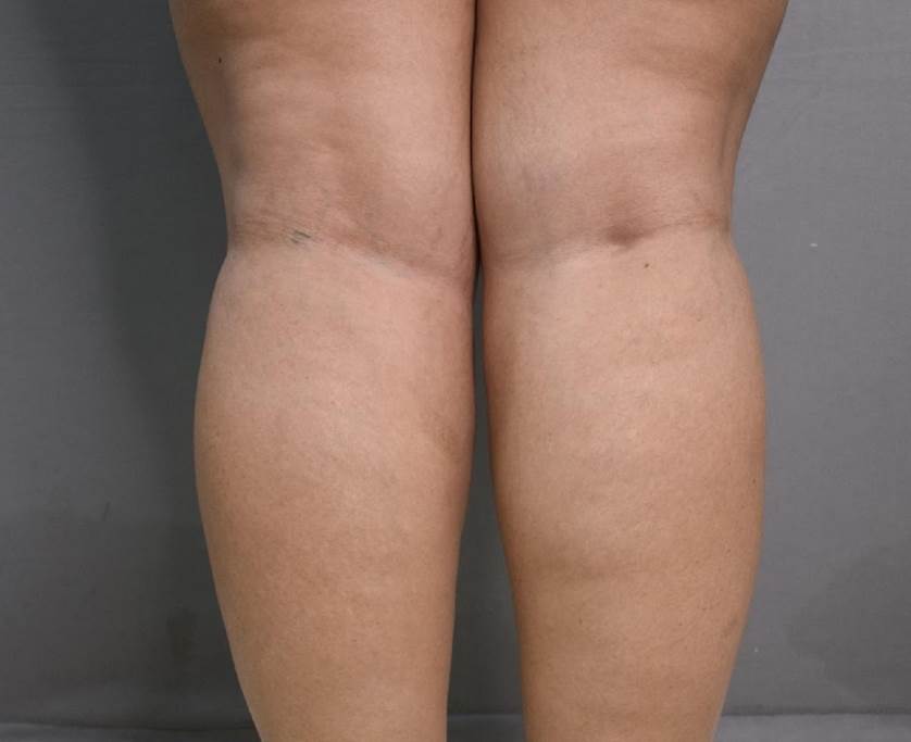 Vaser Lipo Before and After Photos
